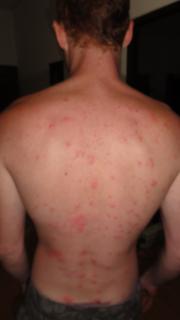 antbites